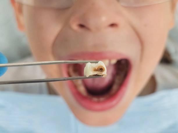 Best Emergency Tooth Extraction in East Village, CT